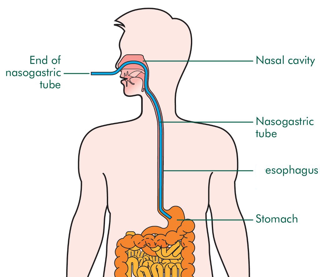 Have You Ever Tried to ForceFeed a Captured Human? The Atlantic